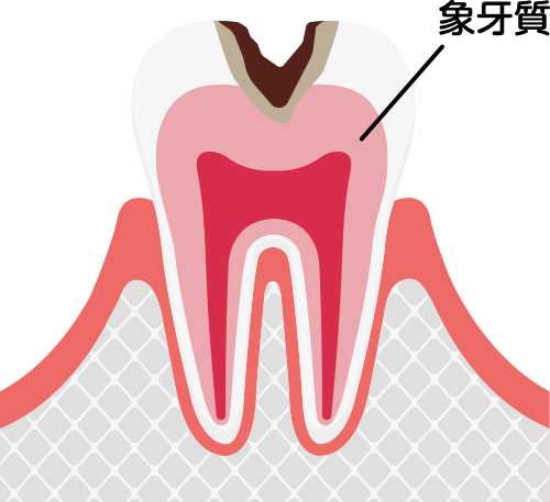 象牙質に達したむし歯（歯の内部まで進行している状態）